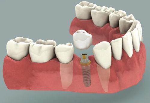 Crown and Bridge Work